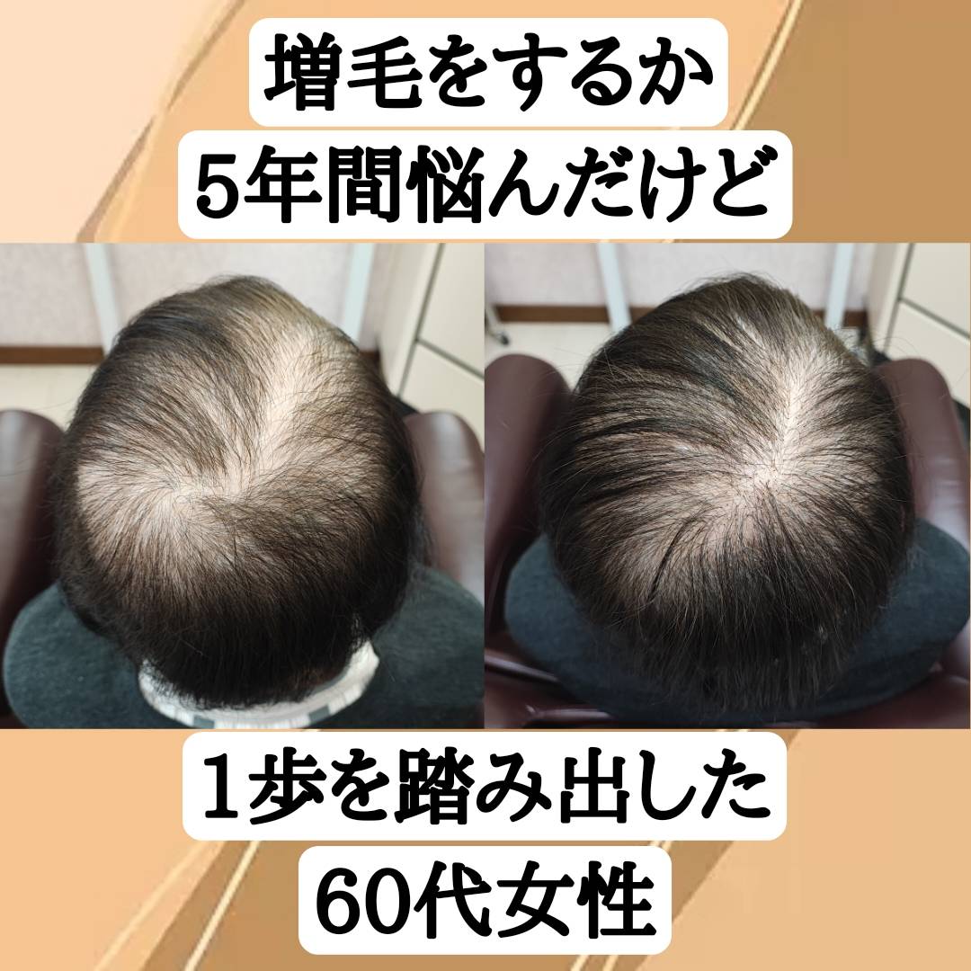 増毛に5年間悩んだ60代女性