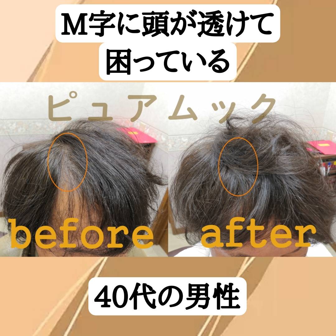 M字に頭が透けて困っている40代男性