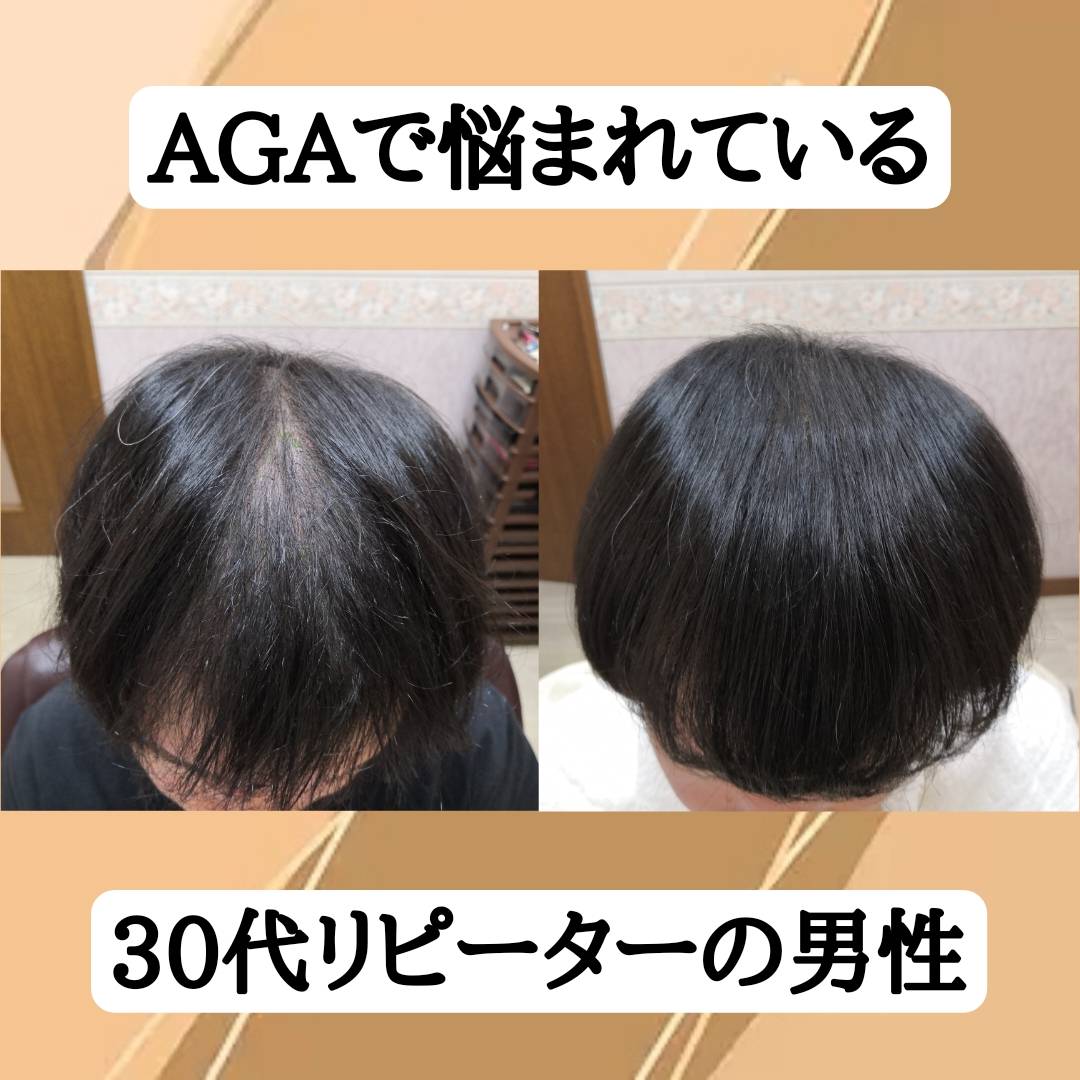 AGAで悩まれている30代男性